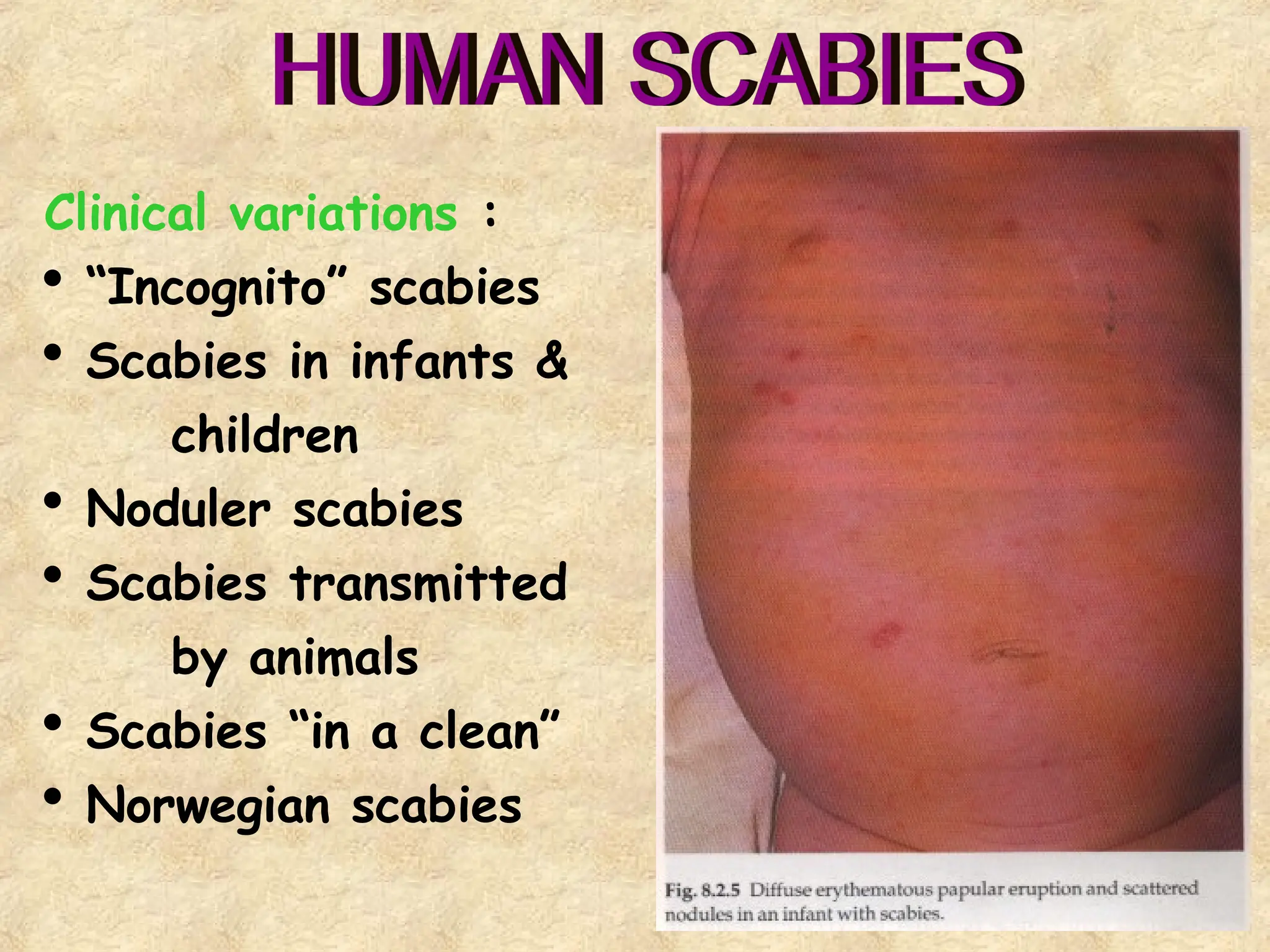 33
Clinical variations :
 “Incognito” scabies
 Scabies in infants &
children
 Noduler scabies
 Scabies transmitted
by animals
 Scabies “in a clean”
 Norwegian scabies
 