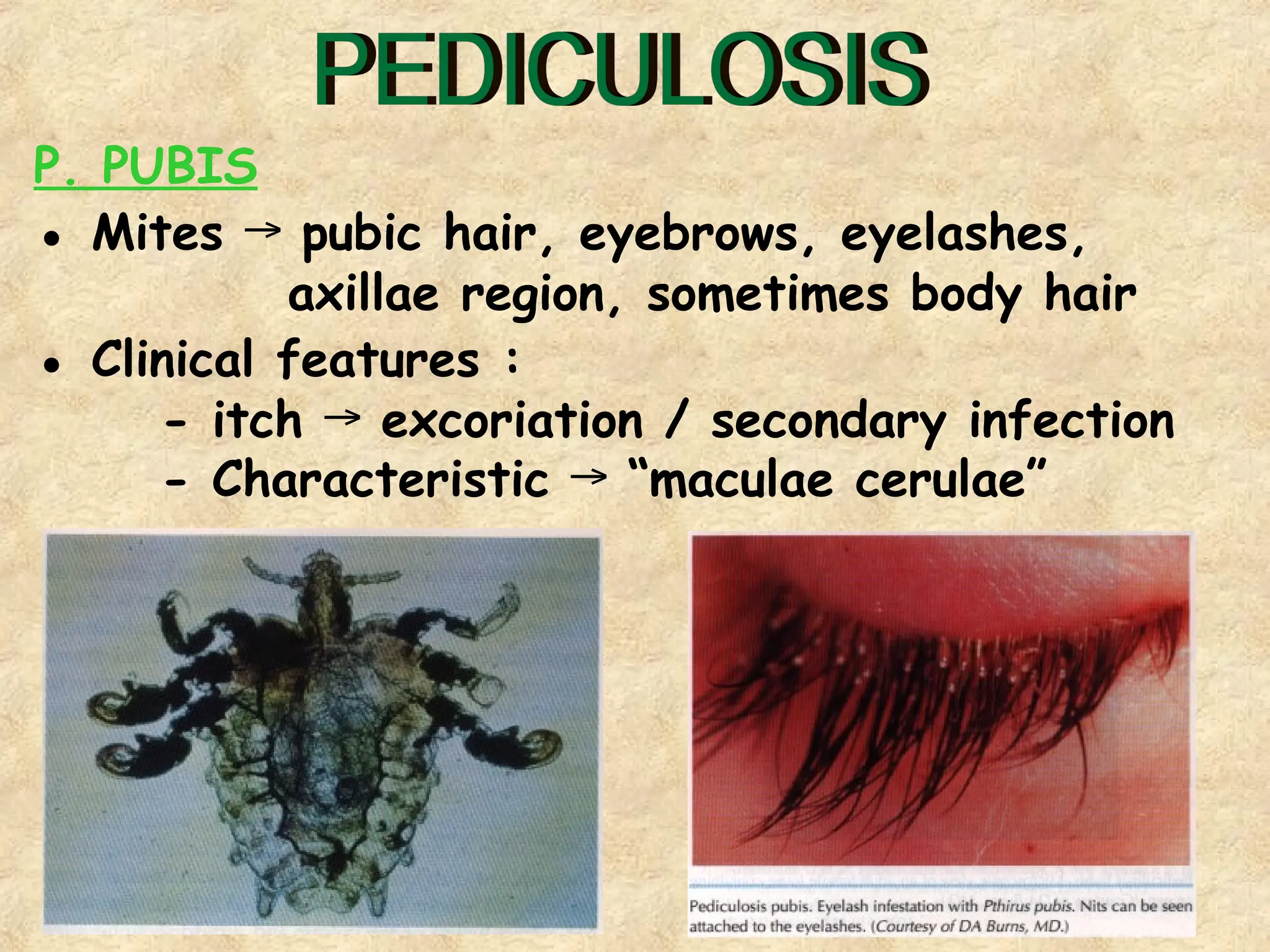 39
P. PUBIS
● Mites pubic hair, eyebrows, eyelashes,
→
axillae region, sometimes body hair
● Clinical features :
- itch excoriation / secondary infection
→
- Characteristic “maculae cerulae”
→
 