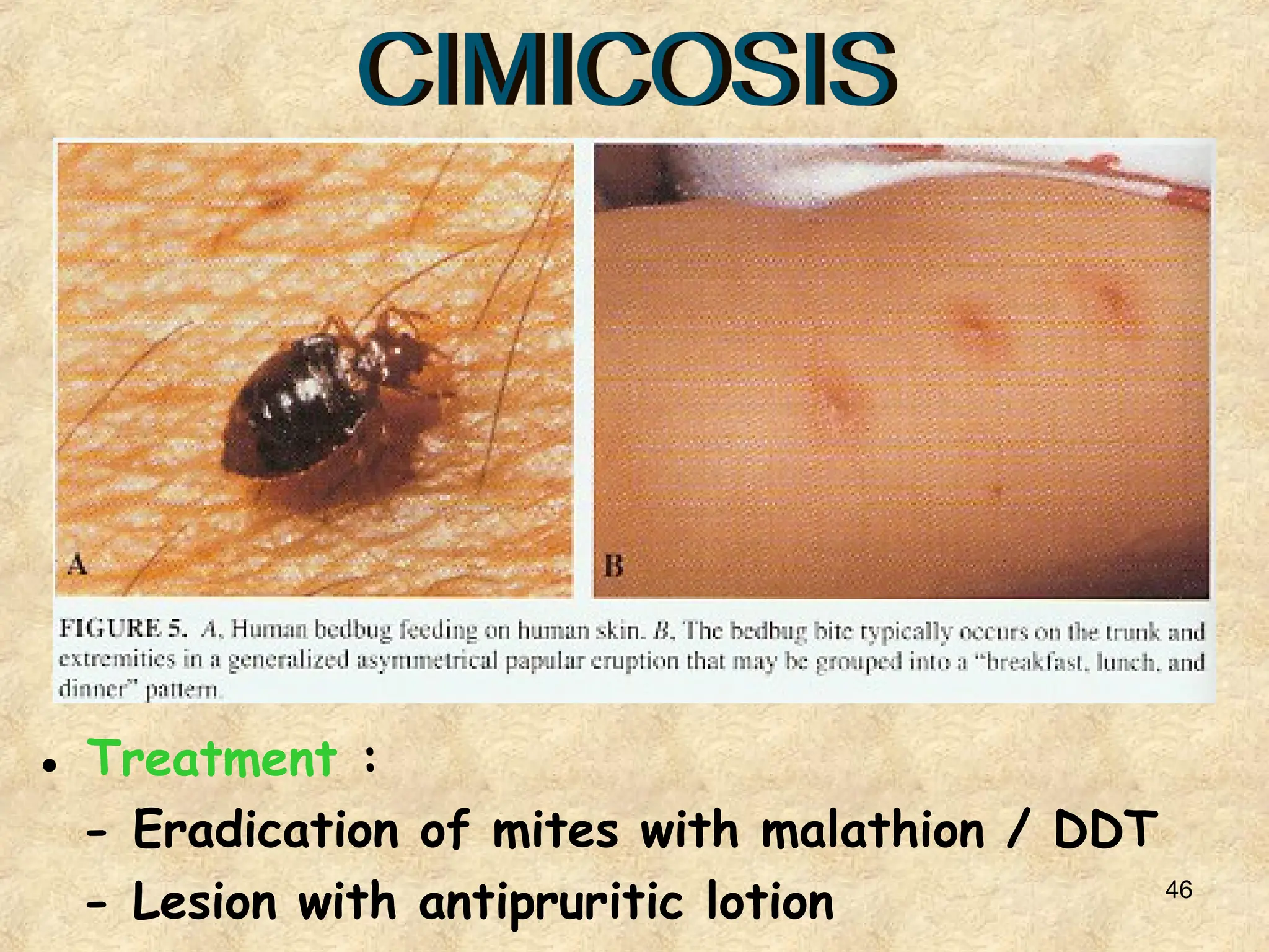 46
● Treatment :
- Eradication of mites with malathion / DDT
- Lesion with antipruritic lotion
 