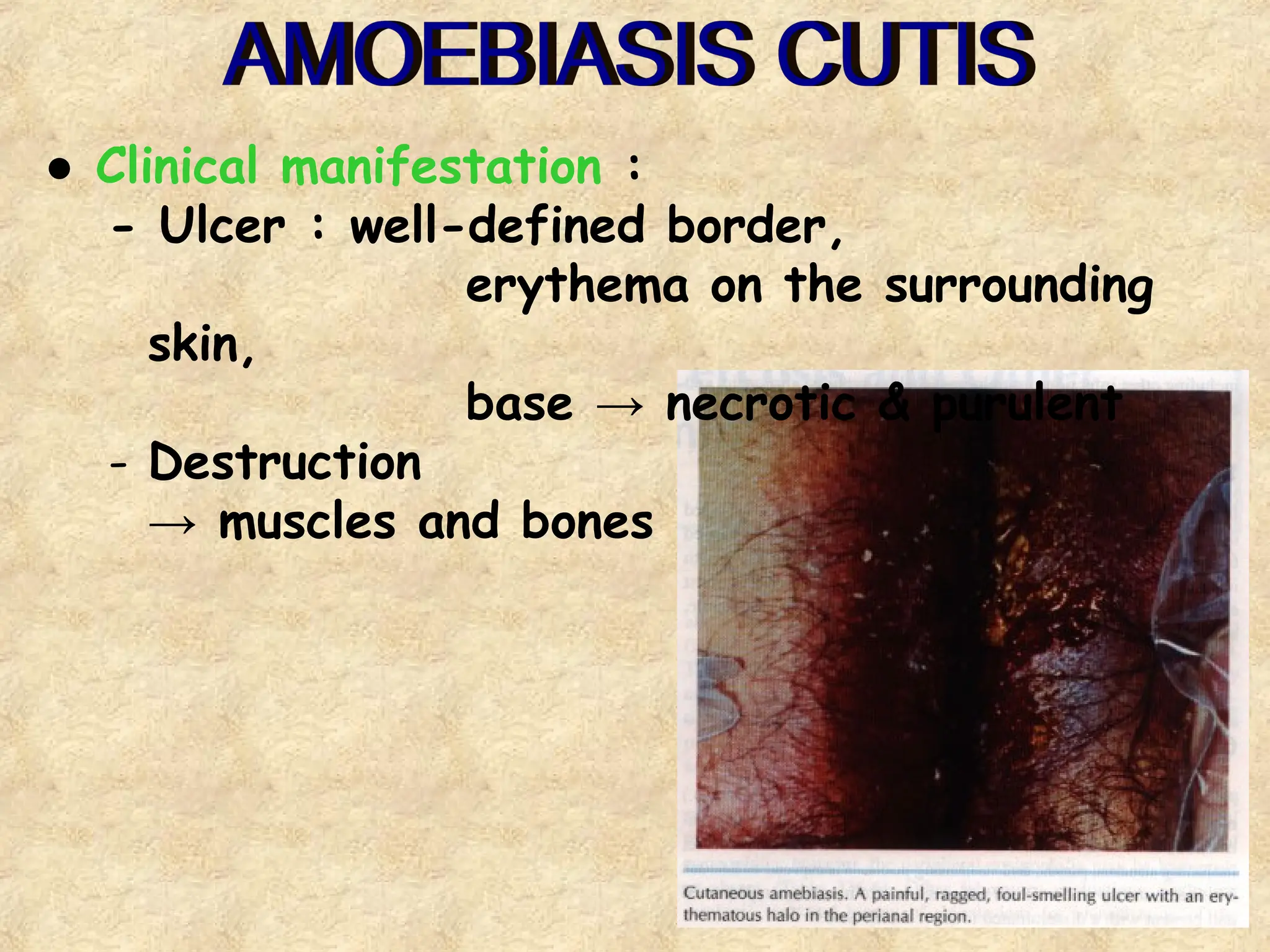 6
● Clinical manifestation :
- Ulcer : well-defined border,
erythema on the surrounding
skin,
base → necrotic & purulent
- Destruction
→ muscles and bones
 