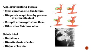 Cholecystoenteric Fistula
• Most common site duodenum
• Diagnosis suspicious by presence
of air in bile duct
• Complication—gallstone ileus
• Other sites fistula—colon.
Saints triad
• Gallstones
• Diverticulosis of colon
• Hiatus of hernia
 
