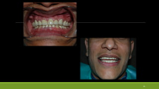 13. FULL MOUTH REHABILITATION in severly attrited dentition | PPTX