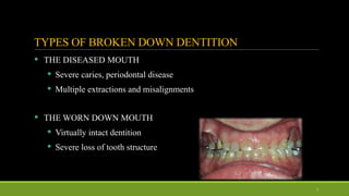 13. FULL MOUTH REHABILITATION in severly attrited dentition | PPTX