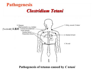 Pathogenesis of tetanus caused by C tetani
Clostridium TetaniClostridium Tetani
Pathogenesis
['kre ni l]ɪ ə 头盖的
 