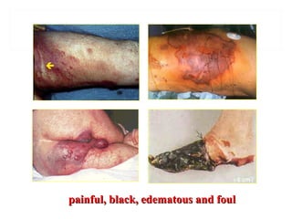 painful, black, edematous and foulpainful, black, edematous and foul
 