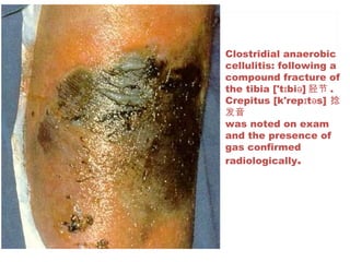 Clostridial anaerobic
cellulitis: following a
compound fracture of
the tibia ['t bi ]ɪ ə 胫节 .
Crepitus [k'rep t s]ɪ ə 捻
发音
was noted on exam
and the presence of
gas confirmed
radiologically.
 