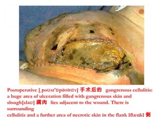 Postoperative [ po st' p r t v]ˌ ʊ ɒ ə ə ɪ 手术后的 gangrenous cellulitis:
a huge area of ulceration filled with gangrenous skin and
slough[sla ]ʊ 腐肉 lies adjacent to the wound. There is
surrounding
cellulitis and a further area of necrotic skin in the flank [flæŋk] 侧
 
