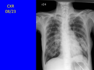 CXR
08/23
 