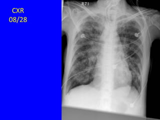 CXR
08/28
 
