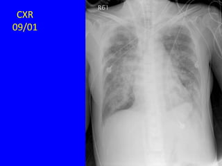 CXR
09/01
 