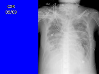 CXR
09/09
 
