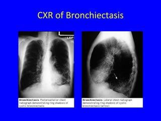 CXR of Bronchiectasis
 