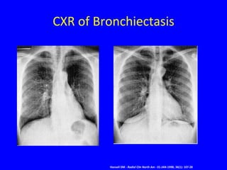 CXR of Bronchiectasis




         Hansell DM - Radiol Clin North Am - 01-JAN-1998; 36(1): 107-28
 