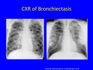 CXR of Bronchiectasis




         Hansell DM - Radiol Clin North Am - 01-JAN-1998; 36(1): 107-28
 