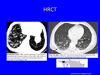 HRCT




       Radiol Clin N Am 43(2005) 513-542
 