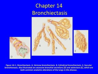 Chapter 14
                               Bronchiectasis



                                                                          C

                                       A
                                                          B
                                                                                E

       D


 Figure 14–1. Bronchiectasis. A, Varicose bronchiectasis. B, Cylindrical bronchiectasis. C, Saccular
bronchiectasis. Also illustrated are excessive bronchial secretions (D) and atelectasis (E), which are
                  both common anatomic alterations of the lungs in this disease.
 