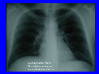 MILD BRONCHIECTASIS
Normal chest radiograph
presents with hemoptysis
 