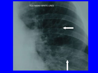 TOO MANY WHITE LINES
 