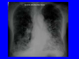 SEVERE BRONCHIECTASIS
 
