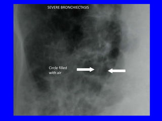 SEVERE BRONCHIECTASIS




Circle filled
with air
 