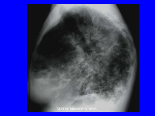 SEVERE BRONCHIECTASIS
 