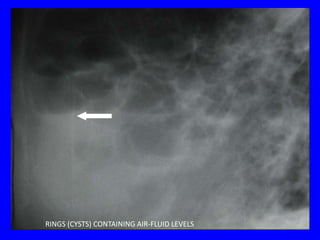 RINGS (CYSTS) CONTAINING AIR-FLUID LEVELS
 