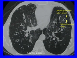 Normal pulmonary
                   artery (pearl)




                       Dilated bronchus
                       (ring)




SIGNET-RING SIGN
 