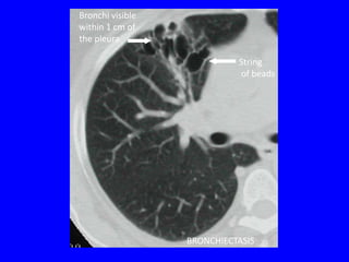 Bronchi visible
within 1 cm of
the pleura

                            String
                            of beads




                  BRONCHIECTASIS
 