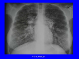 CYSTIC FIBROSIS
 