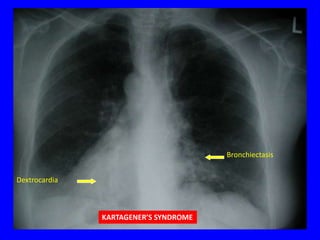 Bronchiectasis


Dextrocardia



               KARTAGENER’S SYNDROME
 