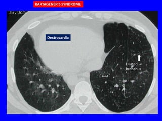 KARTAGENER’S SYNDROME




     Dextrocardia




                        Dilated
                        bronchus
 
