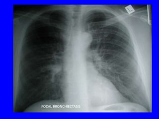 FOCAL BRONCHIECTASIS
 