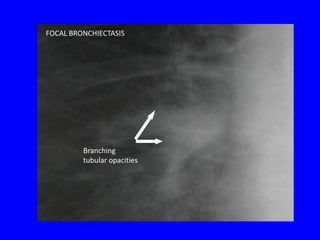 FOCAL BRONCHIECTASIS




         Branching
         tubular opacities
 