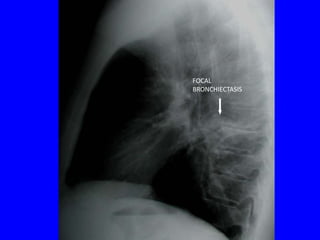 FOCAL
BRONCHIECTASIS
 