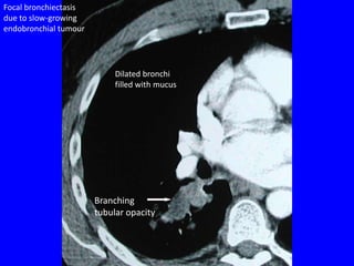 Focal bronchiectasis
due to slow-growing
endobronchial tumour




                            Dilated bronchi
                            filled with mucus




                       Branching
                       tubular opacity
 