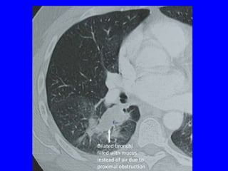Dilated bronchi
filled with mucus
instead of air due to
proximal obstruction
 