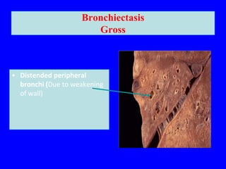 Bronchiectasis
                       Gross



• Distended peripheral
  bronchi (Due to weakening
  of wall)
 