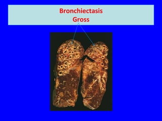Bronchiectasis
    Gross
 