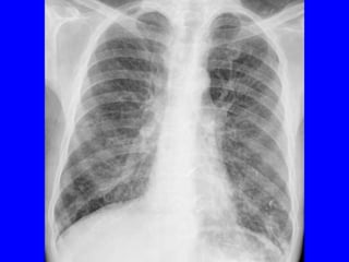 Ct/cxr
 