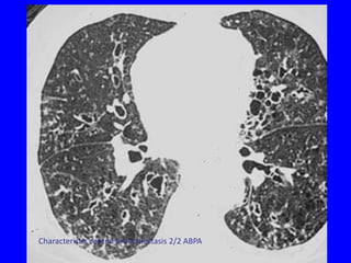 Characteristic central bronchiectasis 2/2 ABPA
 