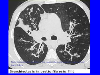 Note characteristic location in the upper lobes and superior segments of
lower lobes
 