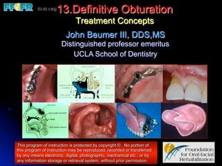 13.Definitive Obturation
                              Treatment Concepts
                         John Beumer III, DDS,MS
                       Distinguished professor emeritus
                           UCLA School of Dentistry




This program of instruction is protected by copyright ©. No portion of
this program of instruction may be reproduced, recorded or transferred
by any means electronic, digital, photographic, mechanical etc., or by
any information storage or retrieval system, without prior permission.
 