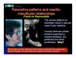 Overlay Temporary Denture 13.edent max overlay dentures | PDF