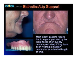 Overlay Temporary Denture 13.edent max overlay dentures | PDF