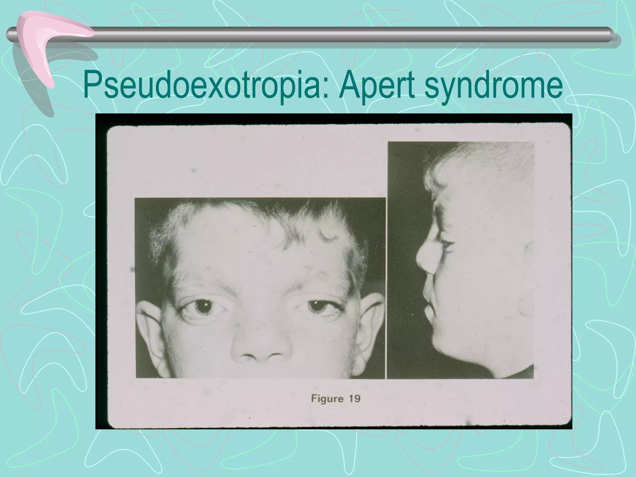 Pseudoexotropia: Apert syndrome
 