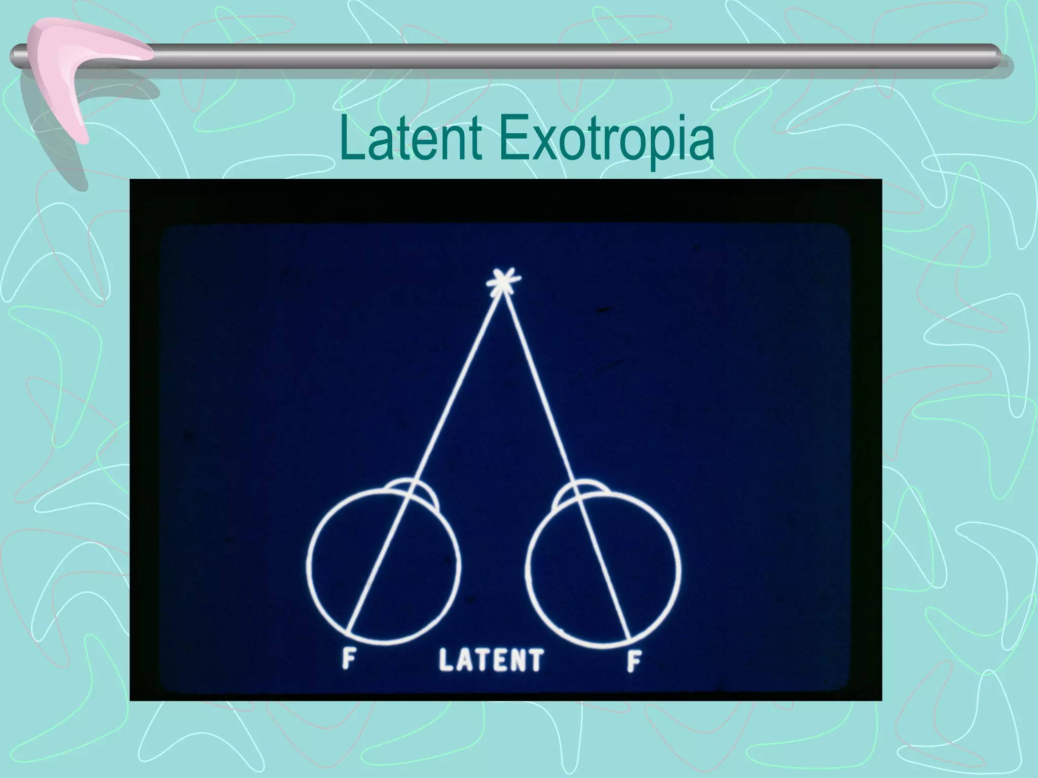 Latent Exotropia
 