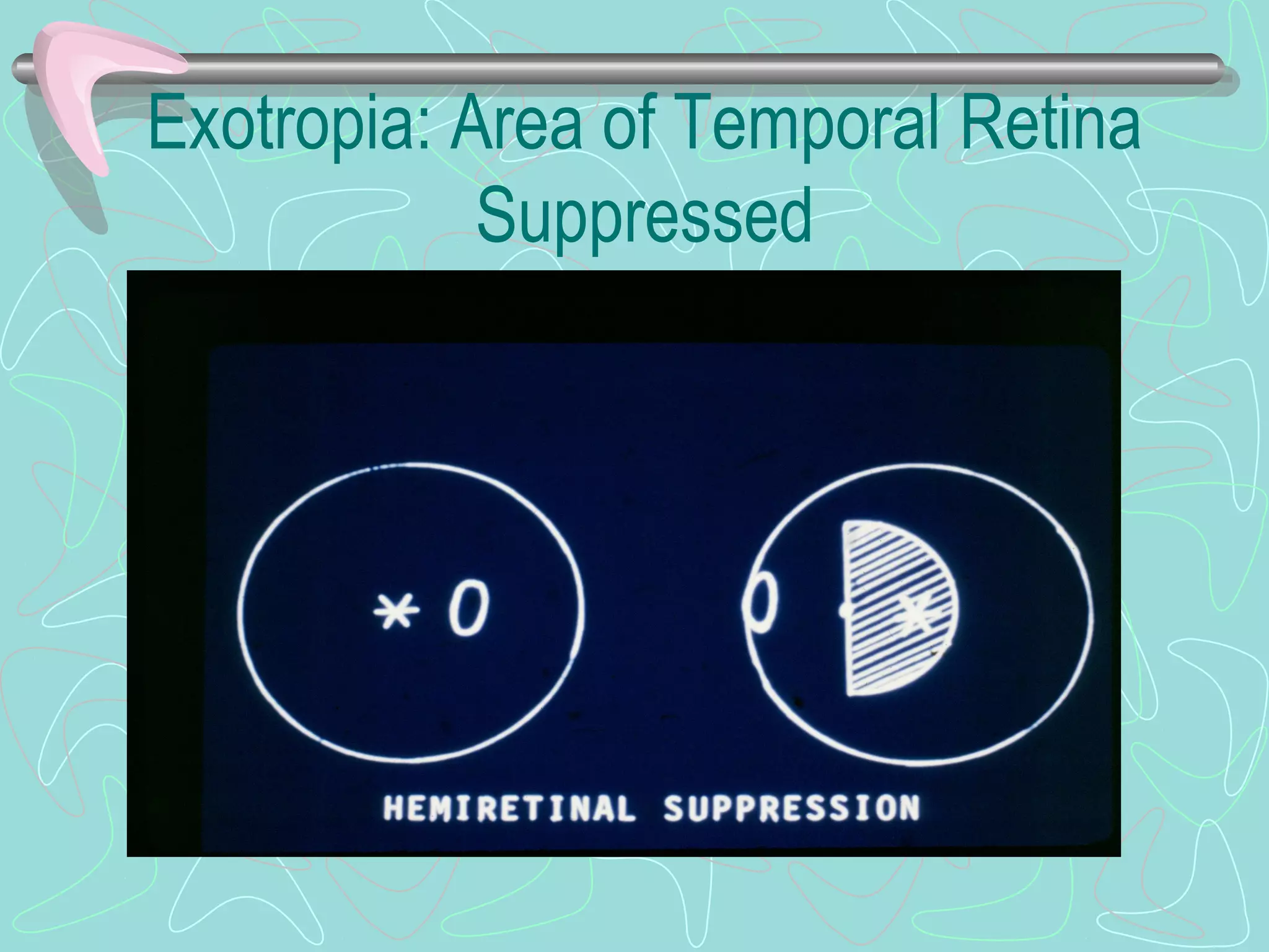 Exotropia: Area of Temporal Retina
Suppressed
 