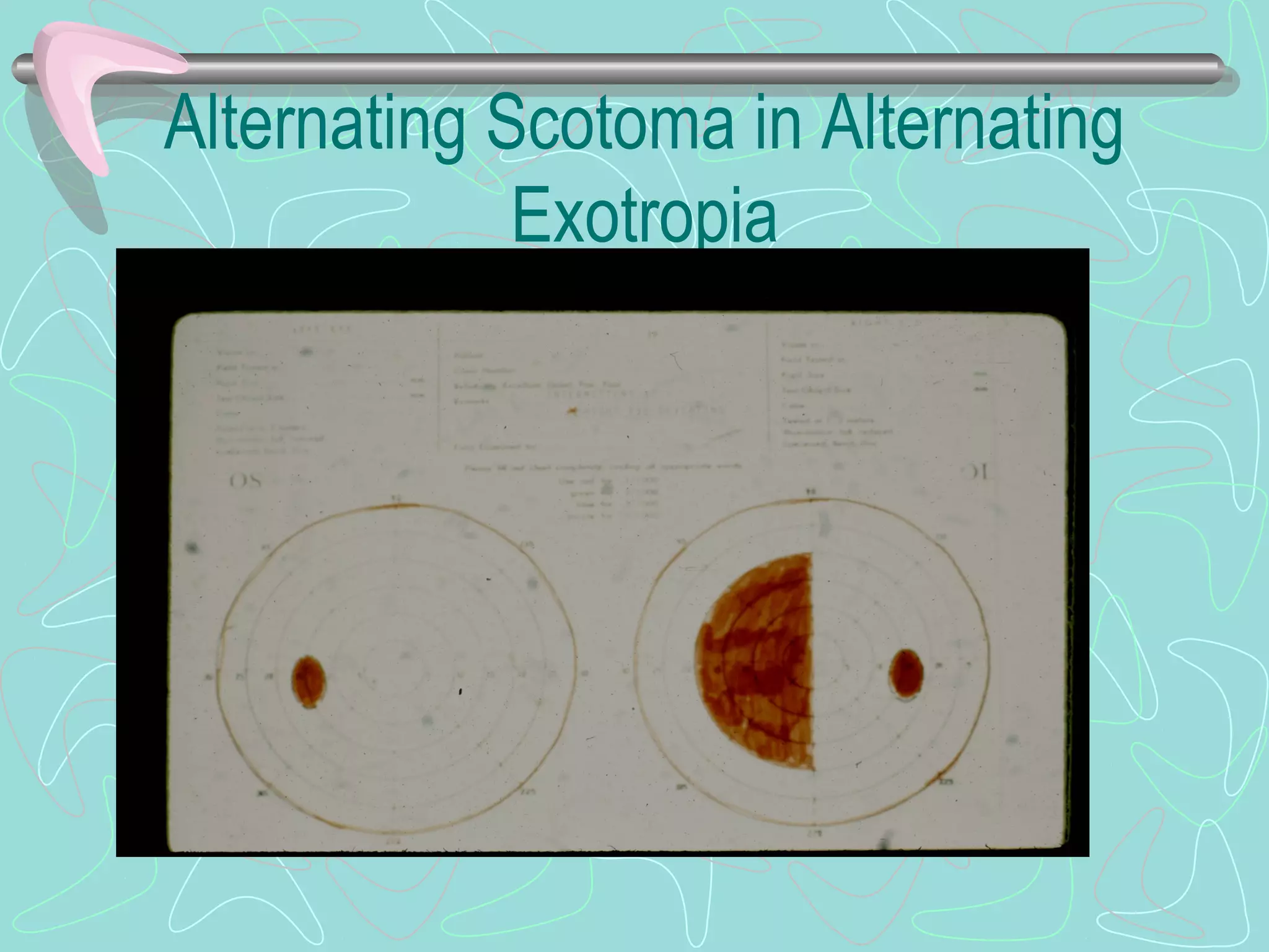 Alternating Scotoma in Alternating
Exotropia
 