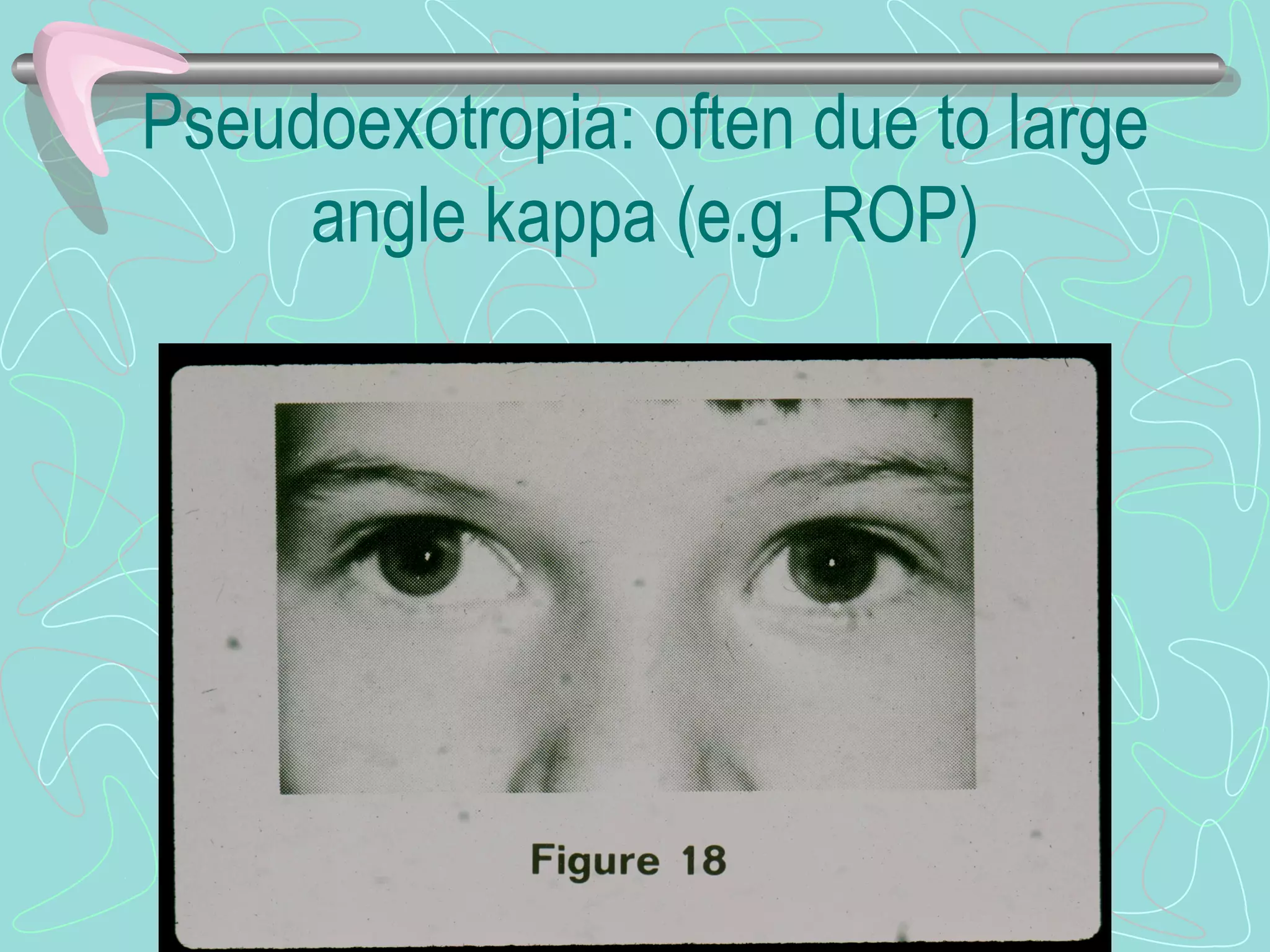 Pseudoexotropia: often due to large
angle kappa (e.g. ROP)
 