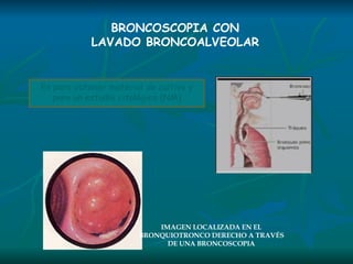 BRONCOSCOPIA CON LAVADO BRONCOALVEOLAR Es para obtener material de cultivo y para un estudio citológico (NM) IMAGEN LOCALIZADA EN EL BRONQUIOTRONCO DERECHO A TRAVÉS DE UNA BRONCOSCOPIA 